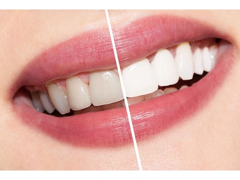 SmileBar dantų balinimas be peroksido